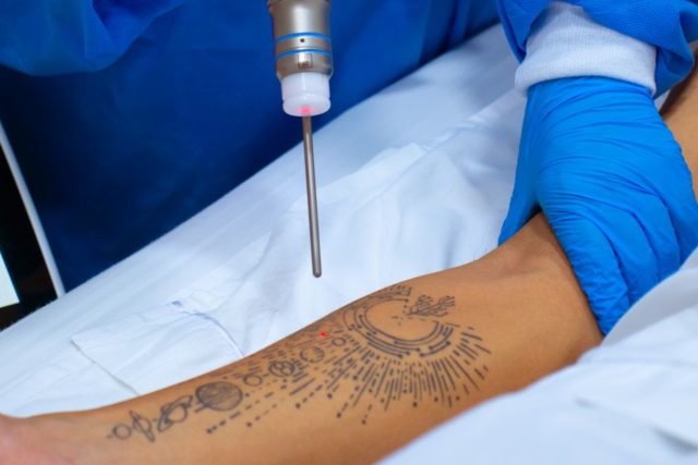 Conoce la última técnica en remoción de tatuajes