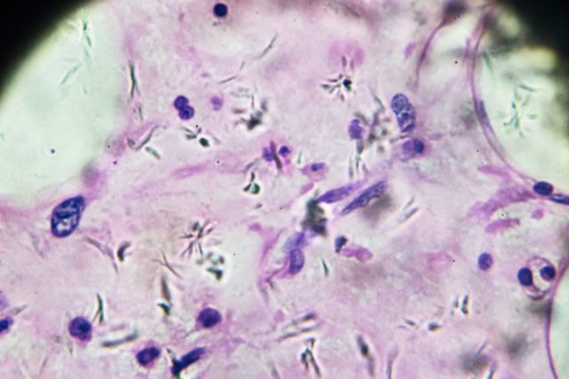 diferencia entre un sarcoma y un carcinoma