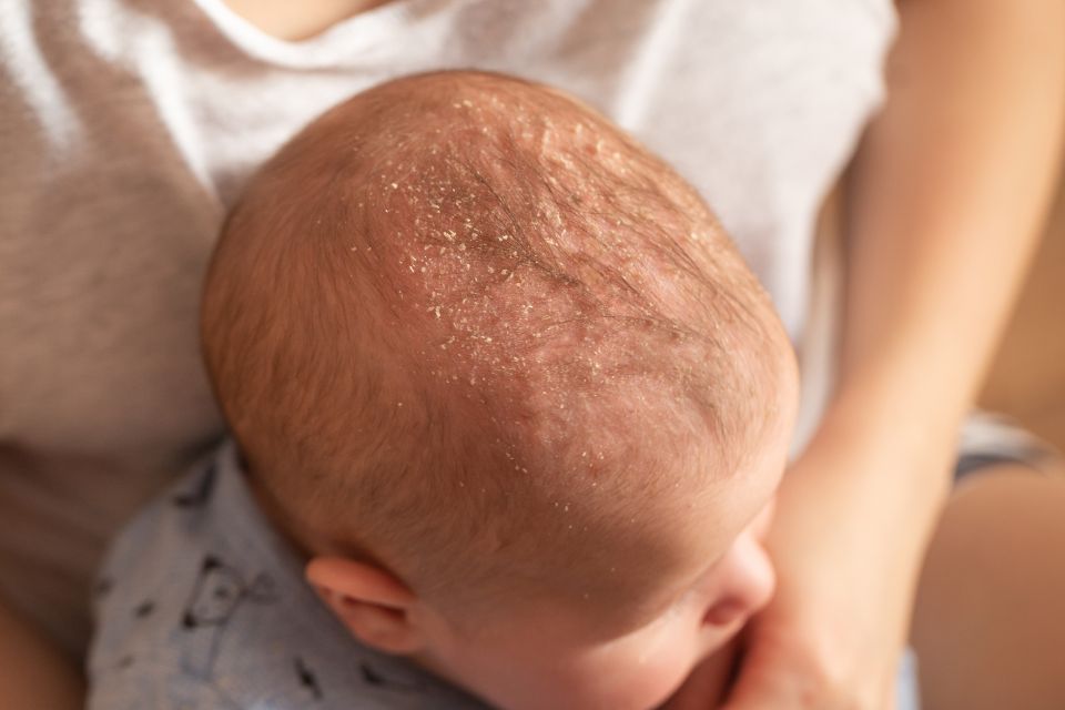 Dermatitis seborreica infantil