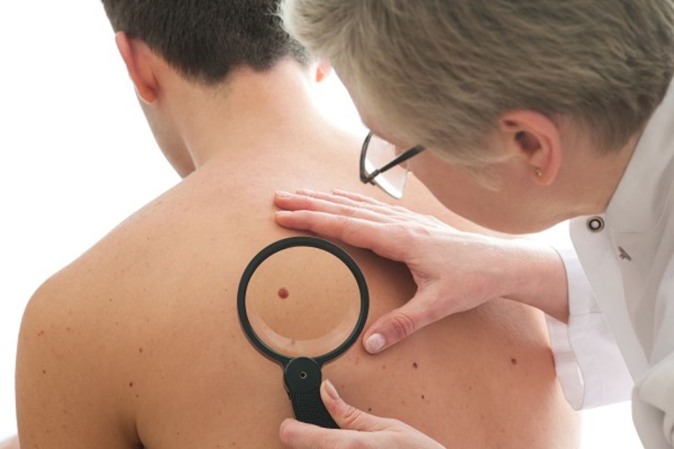 señales de riesgo de cáncer de piel