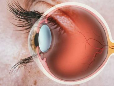 ¿Qué es el edema macular y quienes pueden padecerlo?