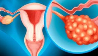 Qué deben saber las mujeres sobre el cáncer de ovario