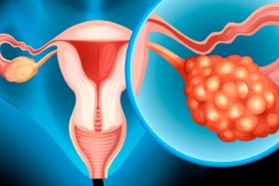 Qué deben saber las mujeres sobre el cáncer de ovario