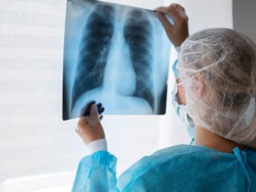 60% de los pacientes con cáncer de pulmón