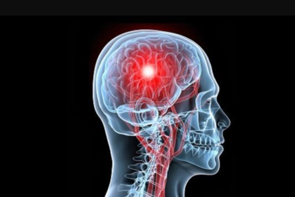 Fast Acv Accidente cerebrovascular: ¿qué es la regla FAST y cómo puede salvar tu ...