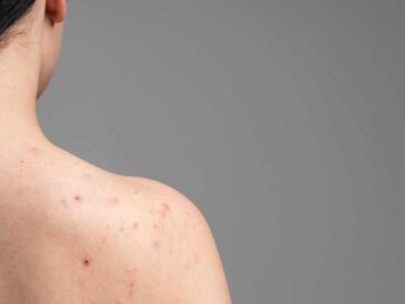 El ABCDE del Melanoma