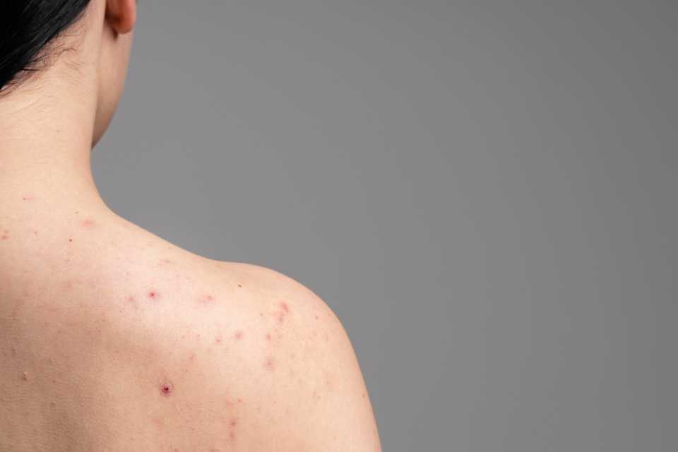 El ABCDE del Melanoma