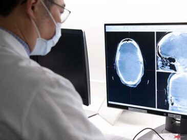 Meningioma: el tumor cerebral más frecuente en adultos y su detección temprana