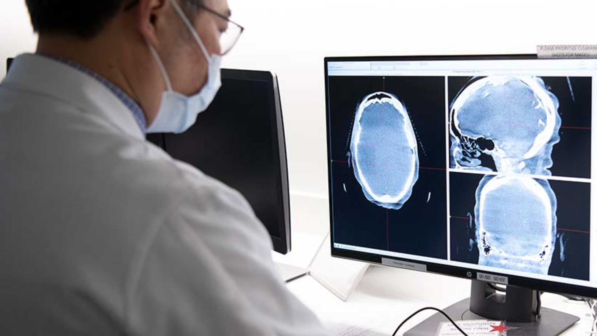 Meningioma: el tumor cerebral más frecuente en adultos y su detección temprana